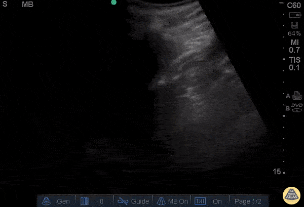 Renal/GU - Moderate Hydronephrosis