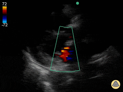 Valvulopathy - Aortic and Mitral Regurgitation