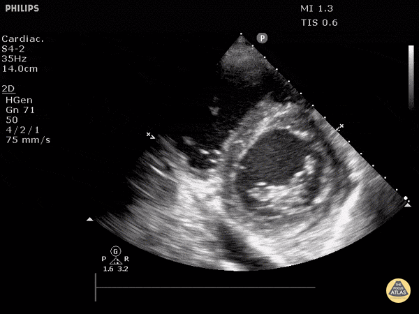 Left Ventricular Dysfunction - Moderately Reduced Ejection Fraction - Basal Parasternal Short Axis