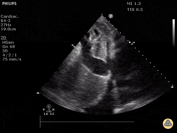 IVC & Abnormal Venous Waveforms - Significantly Enlarged IVC in Acute Heart Failure