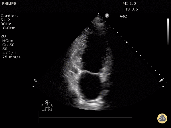 Normal Cardiac Anatomy - Normal Apical 2 Chamber View