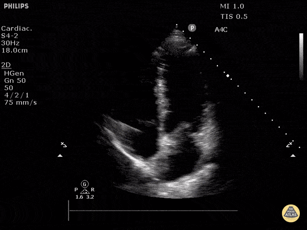 Normal Cardiac Anatomy - Normal Apical 4 Chamber