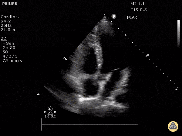 Normal Cardiac Anatomy - Apical 5 Chamber View