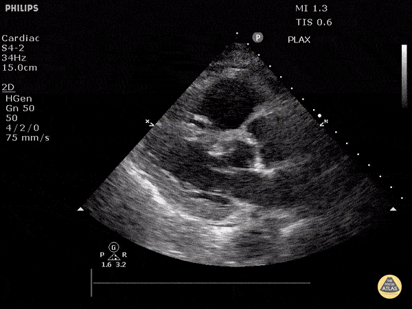 Right Ventricular Dysfunction - Acute Cor Pulmonale (Parasternal Long-Axis View)