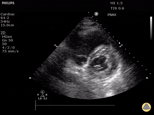 Right Ventricular Dysfunction - Cor Pulmonale (Short)