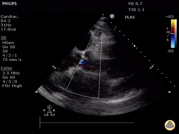 Valvulopathy - Moderate Aortic Regurgitation