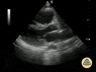 Left Ventricular Dysfunction - Cardiac Arrest with Agonal Rhythm