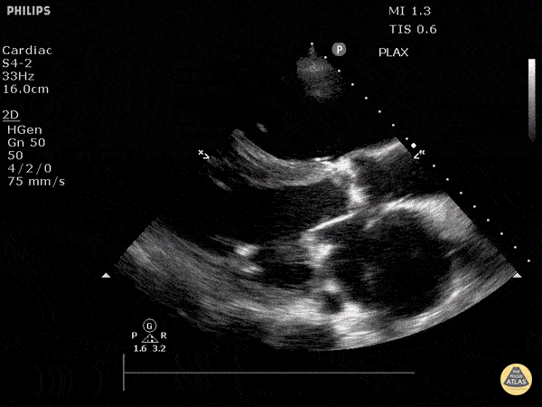 Valvulopathy - Severe Aortic Stenosis