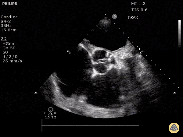 Valvulopathy - Severe Aortic Stenosis