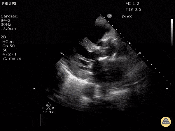 Valvulopathy - Aortic Valve Prosthesis (Long)