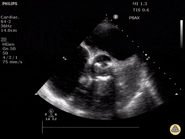 Valvulopathy - Aortic Valve Prosthesis (Short)