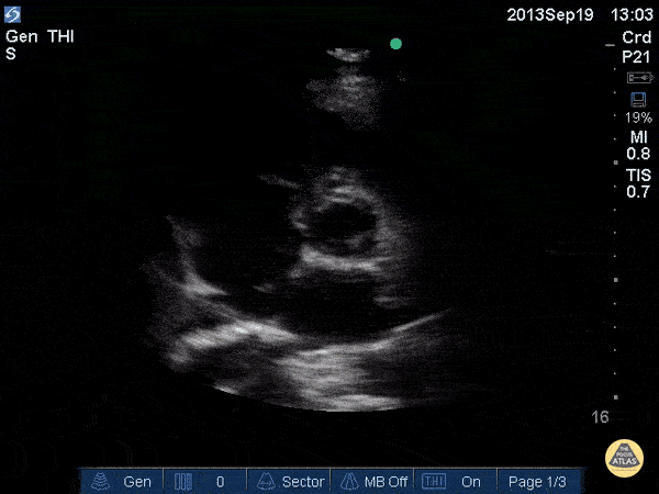 Normal Cardiac Anatomy - Aortic Valve (Short)