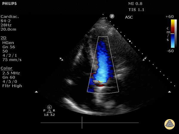 Valvulopathy - Mild Aortic Valve Regurgitation