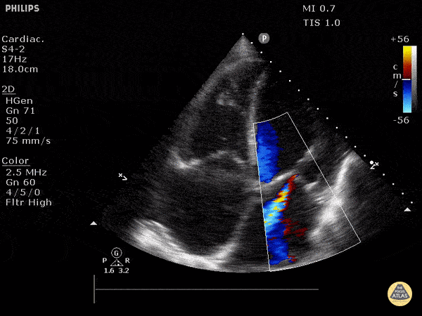 Valvulopathy - Heart Failure with Moderate Mitral Regurgitation