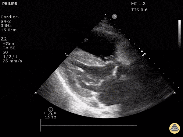 Right Ventricular Dysfunction - Cor Pulmonale (Long)