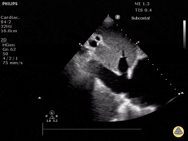 IVC & Abnormal Venous Waveforms - Plethoric Inferior Vena Cava