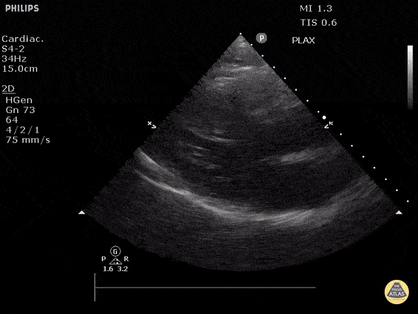 Other Cardiac Pathology - Hypertrophic Cardiomyopathy (Long)