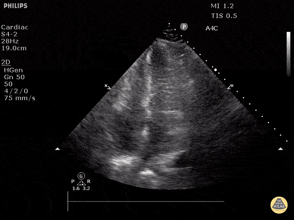 Left Ventricular Dysfunction - Hyperdynamic State