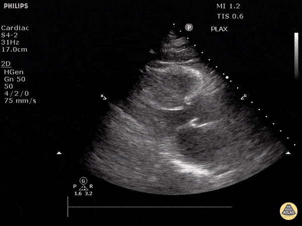 Left Ventricular Dysfunction - Hyperdynamic State (Long)