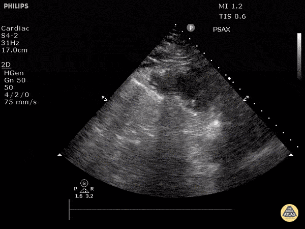 Left Ventricular Dysfunction - Hyperdynamic Left Ventricle (Short)
