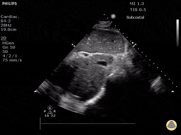 IVC & Abnormal Venous Waveforms - Inferior Vena Cava in Hypovolemia