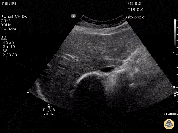 IVC & Abnormal Venous Waveforms - Inferior Vena Cava in Hypovolemia (Transverse)