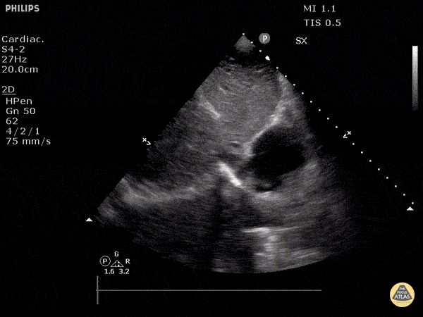 Normal Cardiac Anatomy - Inferior Vena Cava Emptyting into Right Atrium