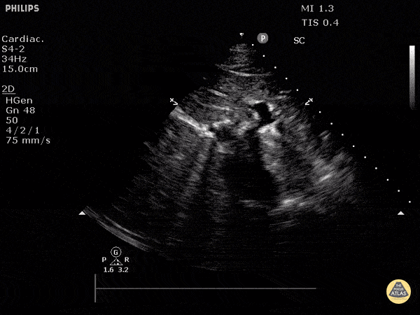 Normal Cardiac Anatomy - Normal Inferior Vena Cava