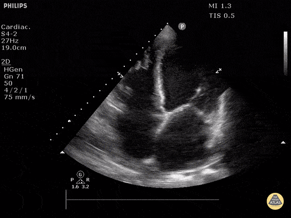 Left Ventricular Dysfunction - Severe Left Ventricular Failure