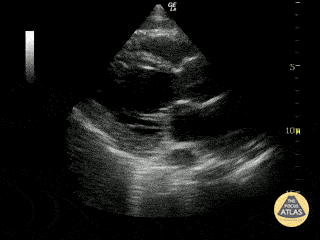 Left Ventricular Dysfunction - Severely Reduced EF