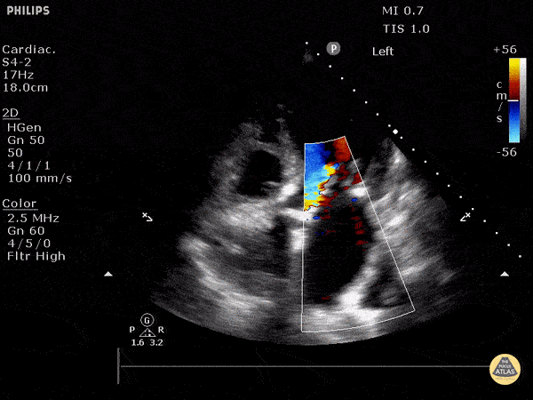 Valvulopathy - Mixed Aortic and Mitral Regurgitation