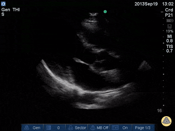 Normal Cardiac Anatomy - Mitral Valve Parasternal Long-Axis View