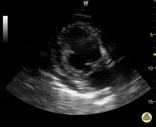 Valvulopathy - Mitral Valve Prolapse (Apical Long-Axis View)