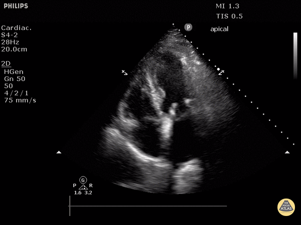 Valvulopathy - Prosthetic Mitral Valve (Apical 4 Chamber View)