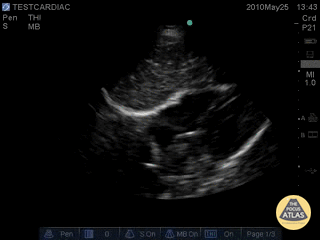 Normal Cardiac Anatomy - Normal Subcostal View