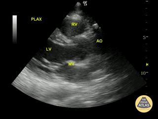 Normal Cardiac Anatomy - Normal Parasternal Long-Axis View