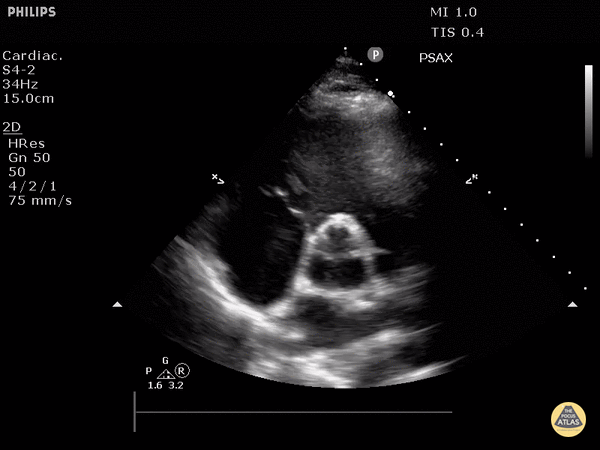 Normal Cardiac Anatomy - Normal Aortic Valve (Parasternal Short-Axis View)