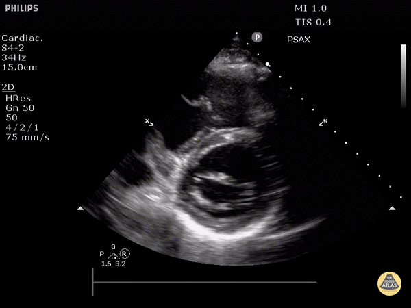 Normal Cardiac Anatomy - Normal Mitral Valve (Parasternal Short-Axis View)