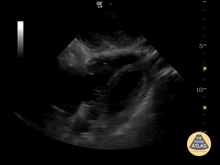 Left Ventricular Dysfunction - Septal Dyskinesis (Subcostal View)