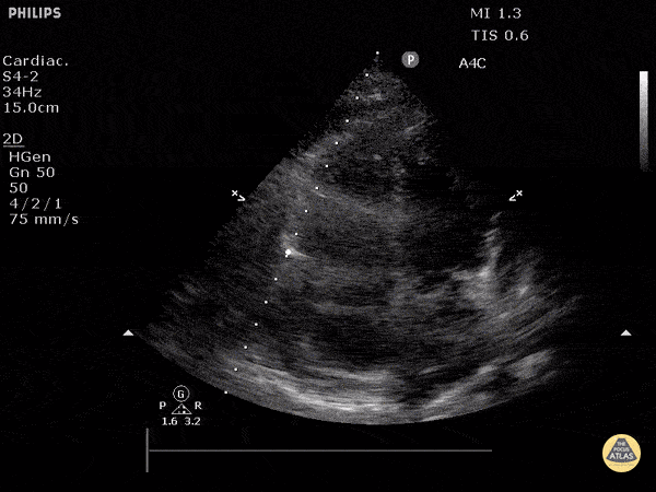 Pericardial Disease - Cardiac Tamponade in Apical View