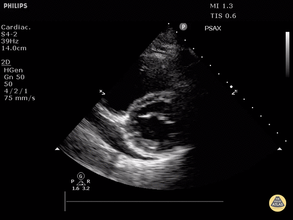 Pericardial Disease - Cardiac Tamponade (Parasternal Short-Axis View)