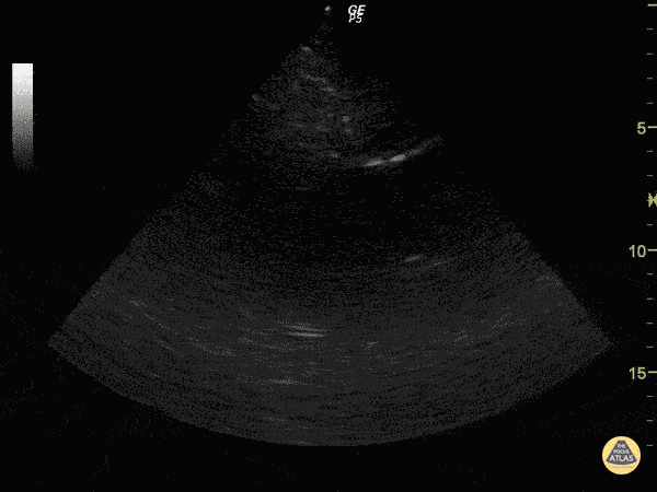Pericardial Disease - Cardiac Tamponade in Stabbed Patient