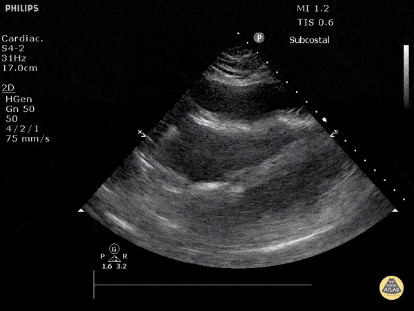 Pericardial Disease - Cardiac Tamponade