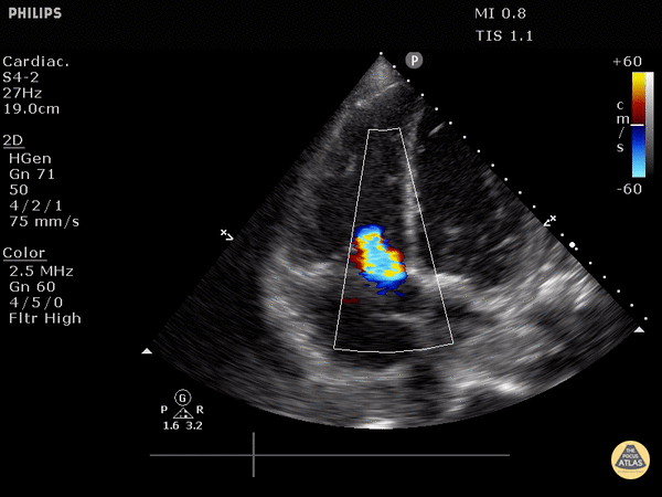 Valvulopathy - Tricuspid Valve Regurgitation