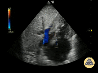Valvulopathy - Tricuspid Valve Regurgitation