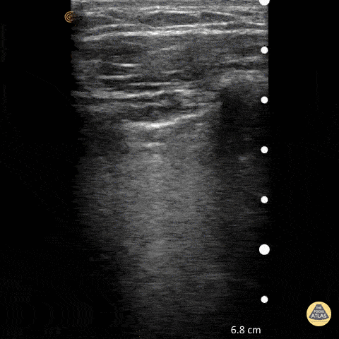 Pulmonary - Normal Lung Slide