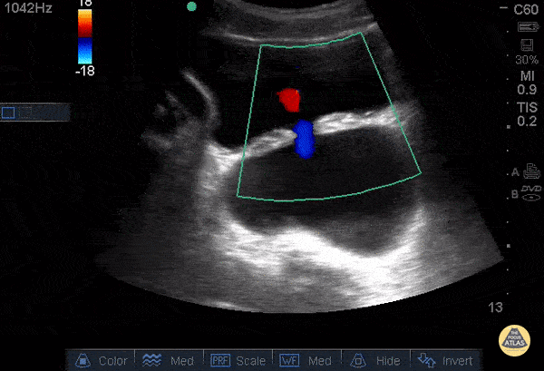 Renal/GU - Bladder Diverticulum