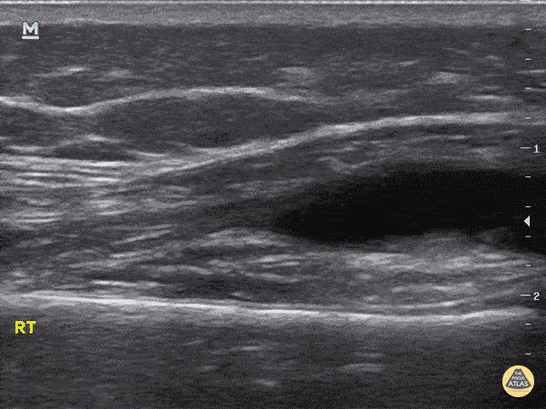 Pediatrics - Knee Effusion - Septic vs. Lyme Arthritis