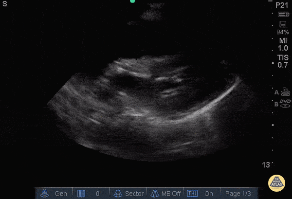 Left Ventricular Dysfunction - Ventricular Fibrillation