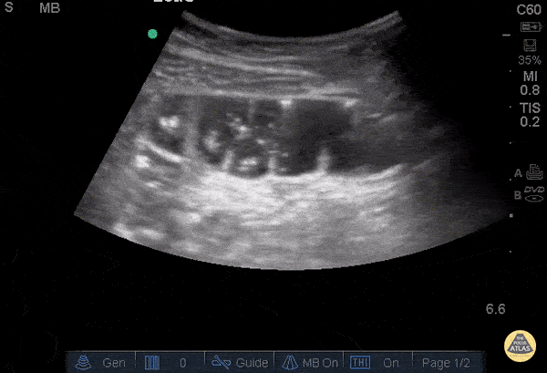 Bowel-GI - Incarcerated Hernia with SBO
